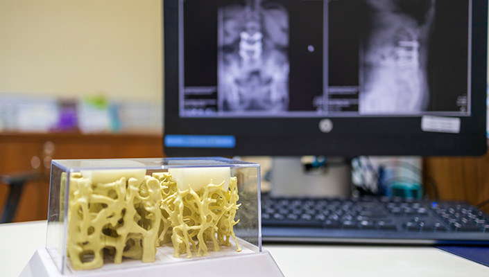 osteoporosis