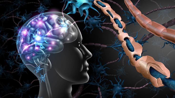 Multiple sclerosis nerve disorder and damaged myelin with 3D illustration. NUI Galway